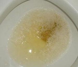 尿黄有泡沫 尿黄是什么原因引起的