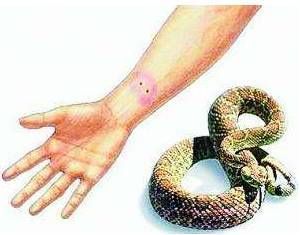 蛇咬伤的急救方法 被蛇咬了有什么症状