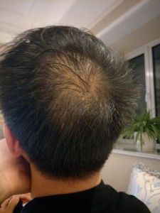 治疗脱发的有效方法 白头发怎么治才能黑