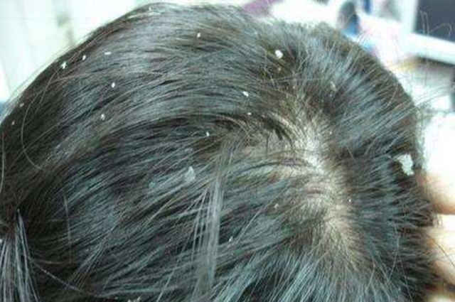 头螨会传染吗 肾亏型脱发